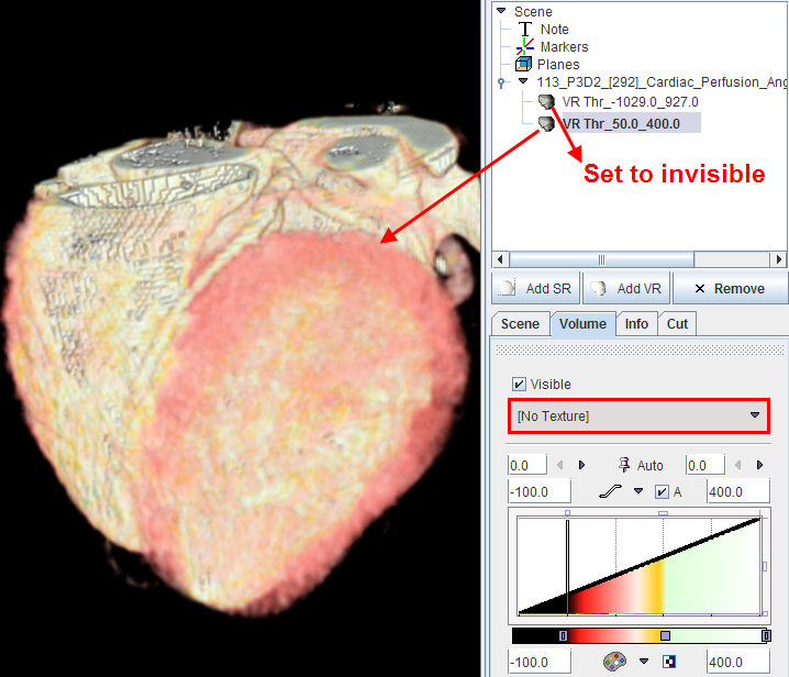 P3D SPECT/CT Fusion 2