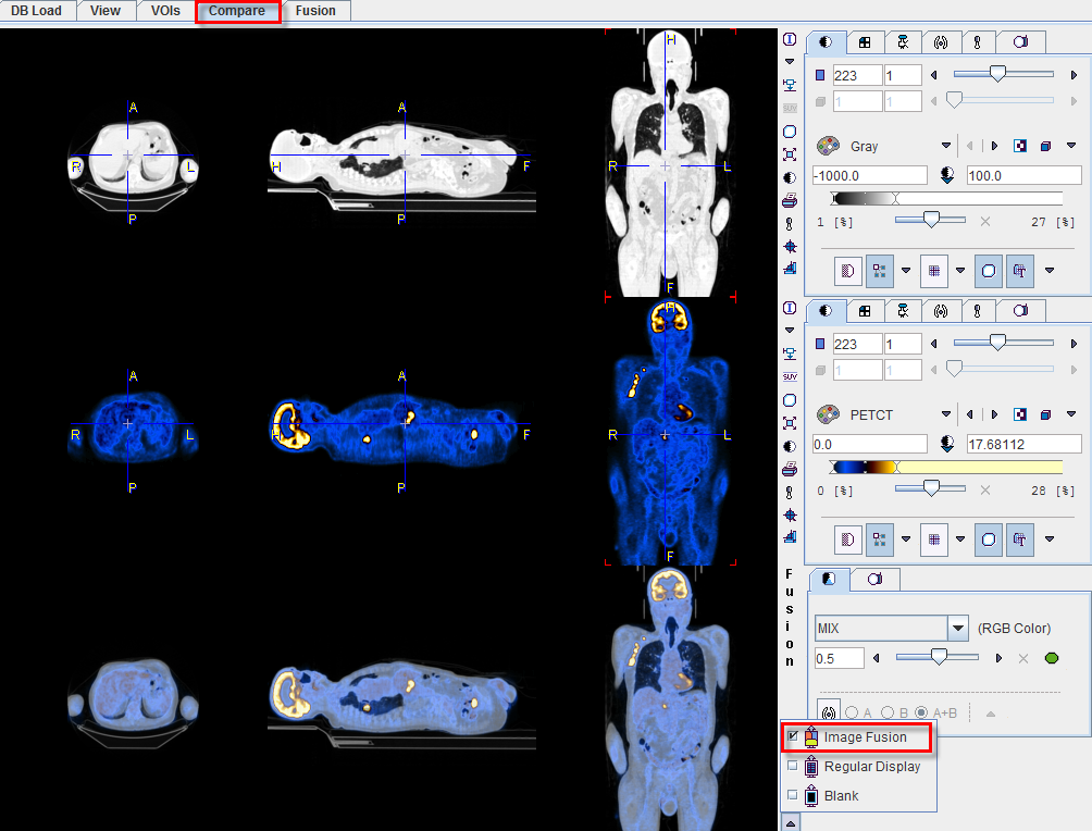 PET/CT Fusion image