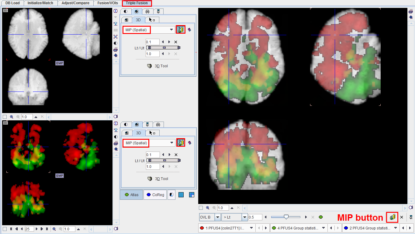 Triple Fusion MIP